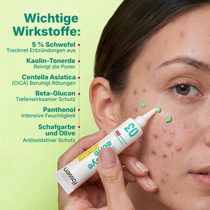 Bye-bye Acne Behandlung – gezielte Pflege gegen Pickel