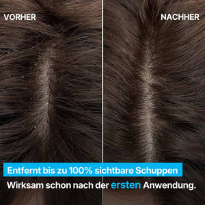 KOPFHAUT MIT SICHTBAREN SCHUPPEN VOR DER ANWENDUNG | Rossen Kosmetik