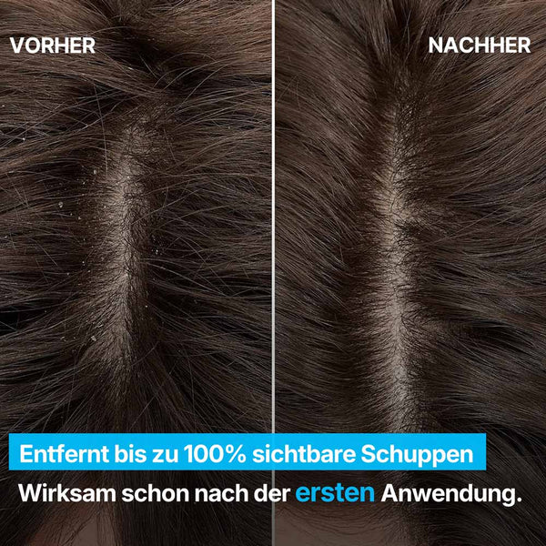 KOPFHAUT MIT SICHTBAREN SCHUPPEN VOR DER ANWENDUNG | Rossen Kosmetik