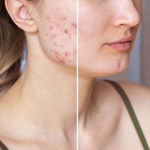 SOS Serum gegen Akne & Pickel | Rossen Kosmetik